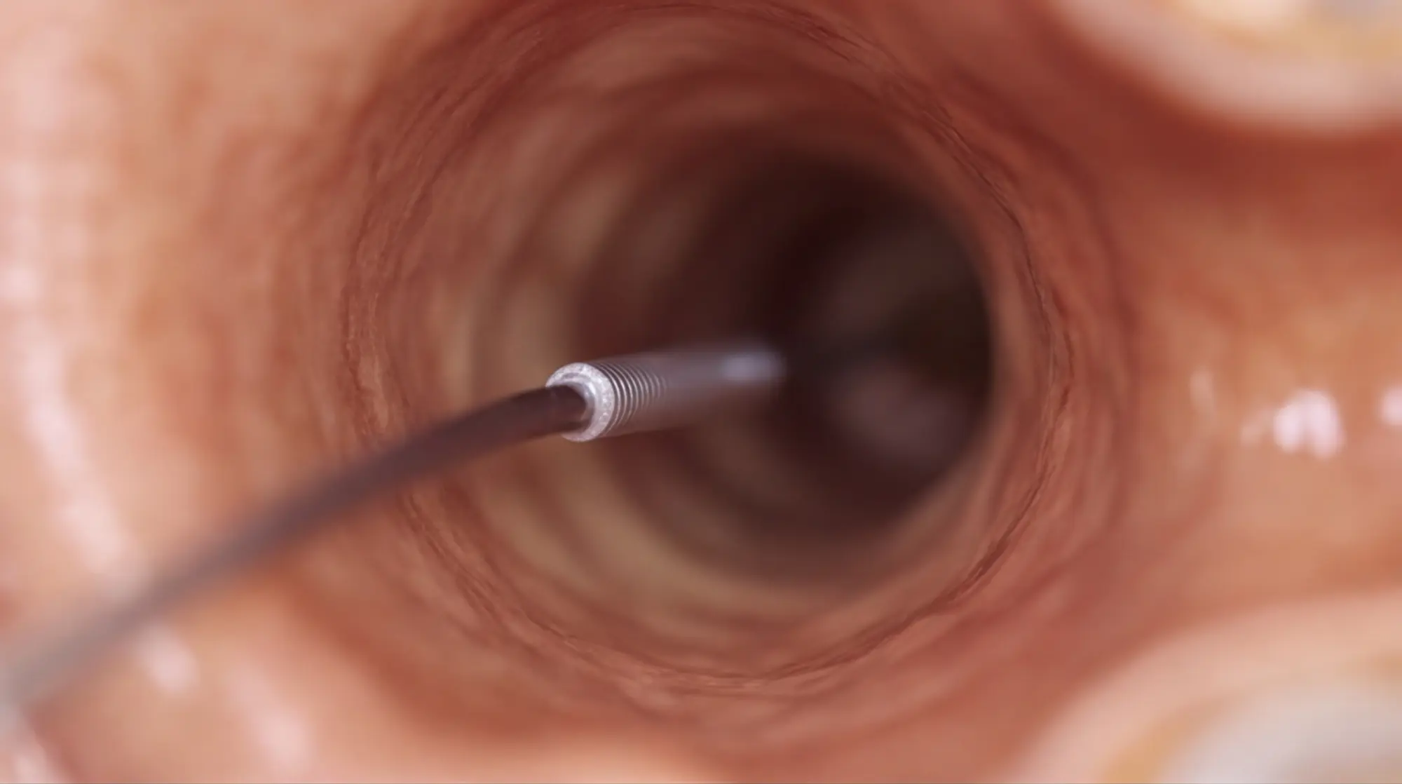 Ear canal — medical probe in the external auditory meatus, endoscopic view