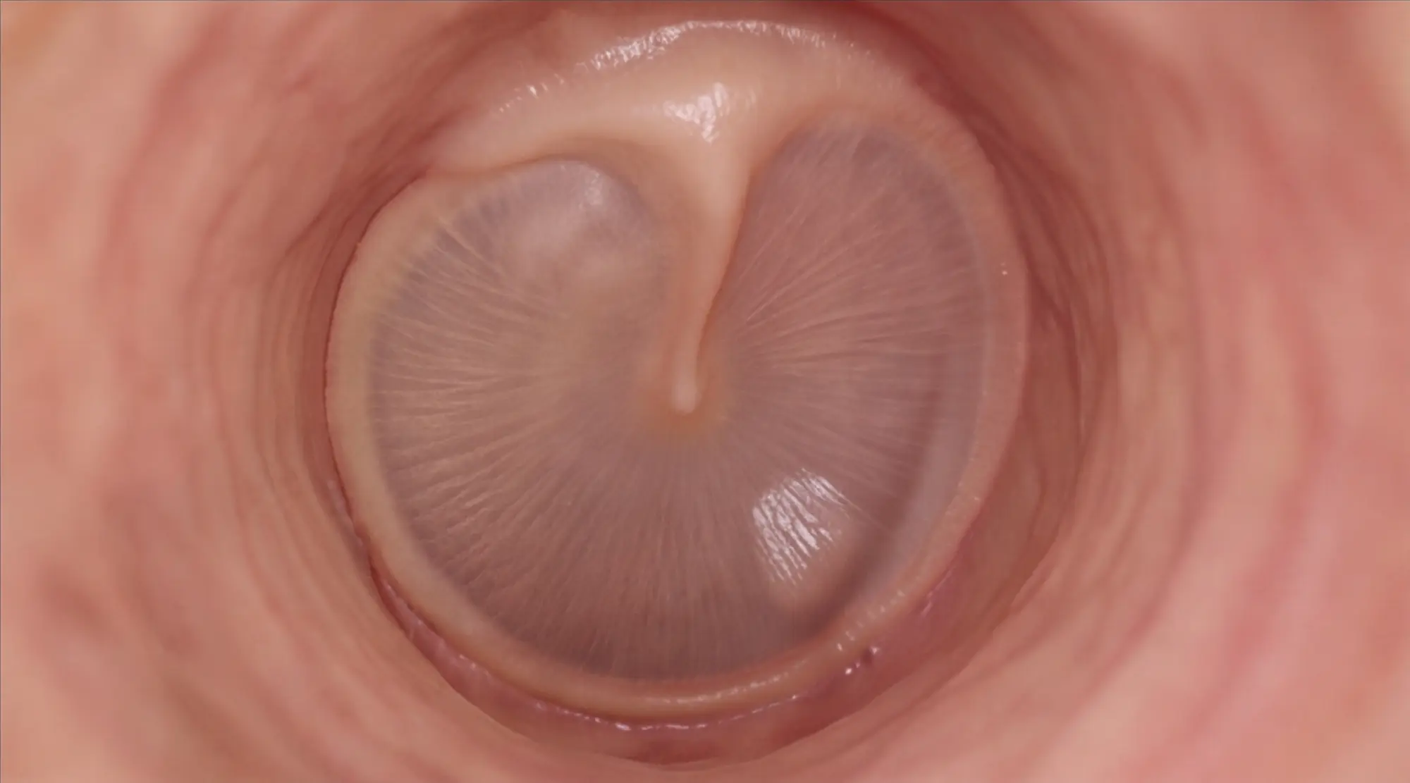 Tympanic membrane — frontal close-up showing fibrous layers and umbo